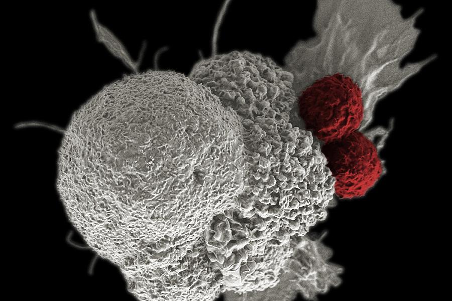 Scanning electron micrograph of an oral squamous cancer cell (white) being attacked by two cytotoxic T cells (red), part of a natural immune response