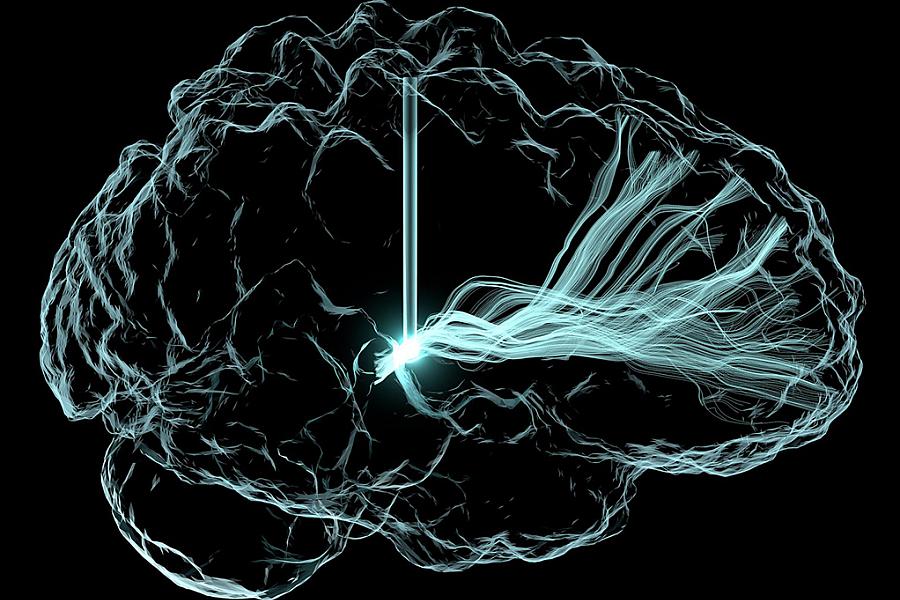 Artistic rendering of deep brain stimulation (DBS), with an outline of brain and vertical lines that represent wire leads with a single electrode that has been inserted deep within the brain to reach a region involved in cognition, the central thalamus.