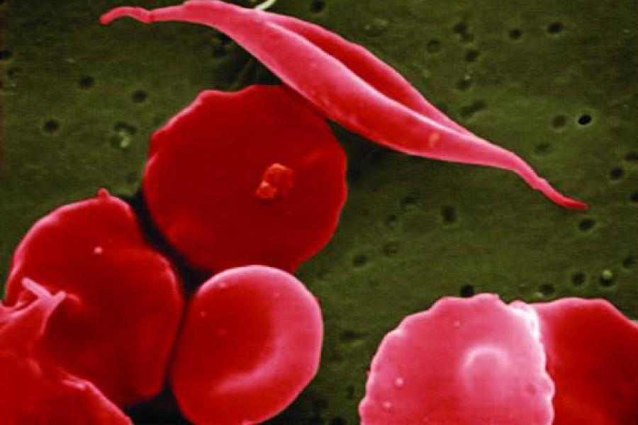 Magnified red blood cells and sickled cells.