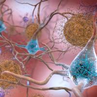 Beta-amyloid plaques and tau in the brain