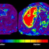 Two liver elastograms.