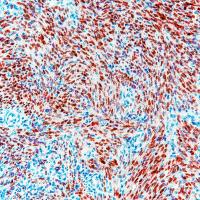 Expression of HHV-8 LANA in Pediatric Kaposi Sarcoma