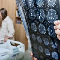 Image of a cranial MRI sheet being held by a medical professional with an older women in a hospital bed in the background.
